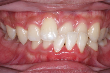 Anterior Crossbite